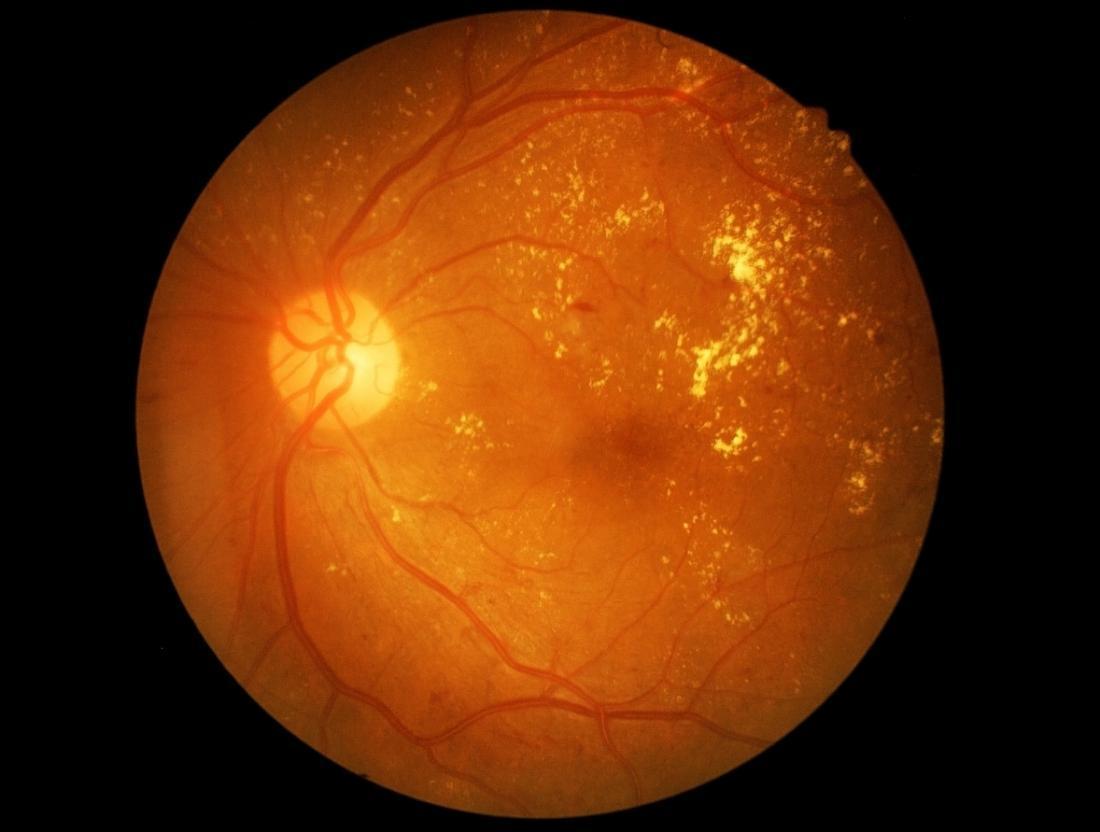 Retina Image of a Person with Diabetic Retinopathy